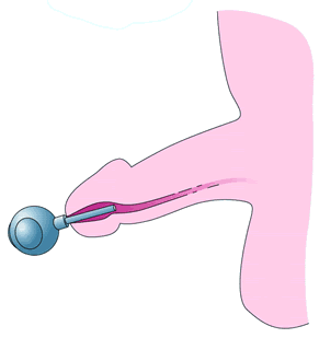 Topical steroid injection side effects