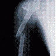 breakbones