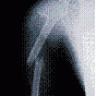 breakbones