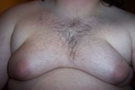 Male with Severe Estrogen Induced Gynecomastia
